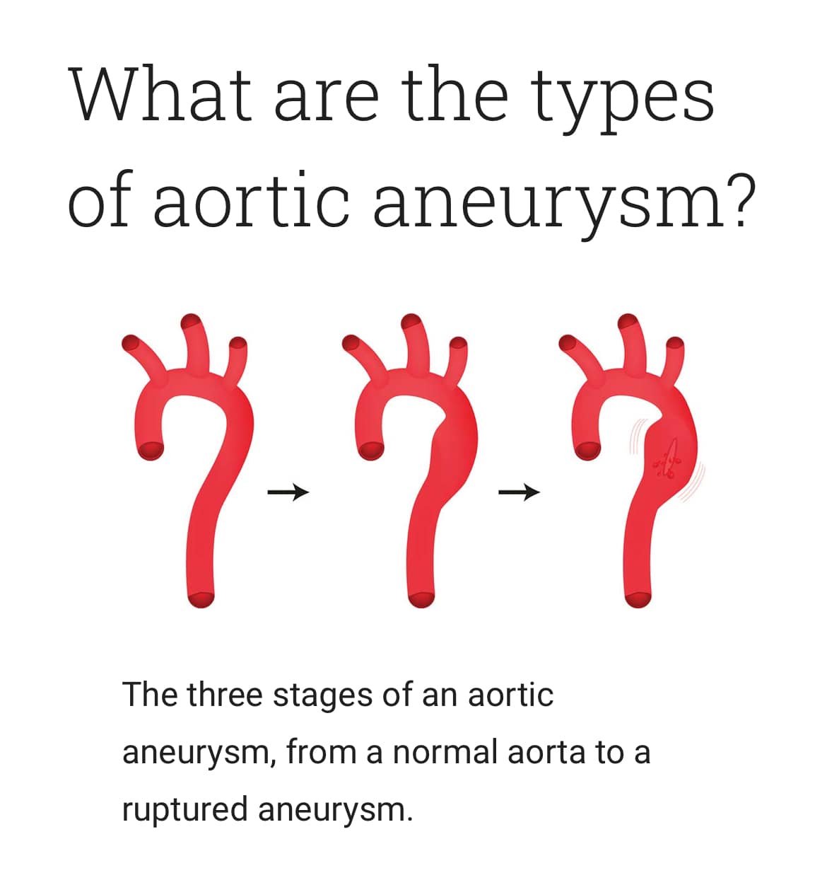 Read more about the article Aortic Stability and Chronicity