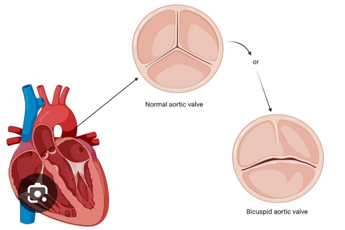 Read more about the article Bicuspid aortic valves and exercise